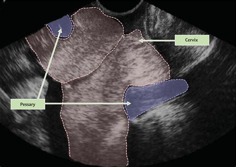 Cervical Pessary In Pregnant Women With A Short Cervix Pecep An Open