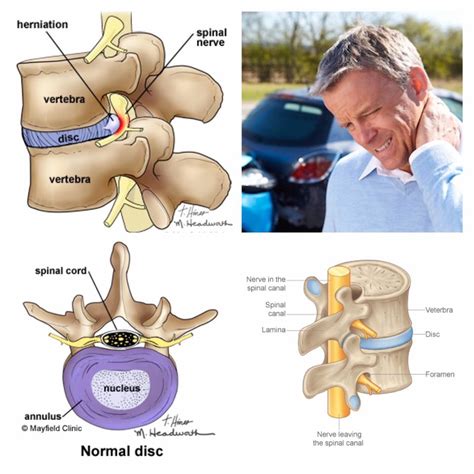 Spinal stenosis is most commonly caused by natural aging, however it can be cause be trauma such as a car accident. BACK & NECK PAIN AFTER A CAR ACCIDENT - KLG | Kurzman Law ...