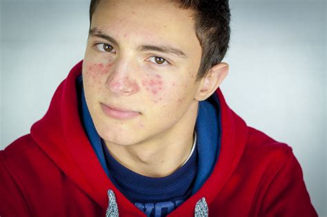Acne Young Mens Health