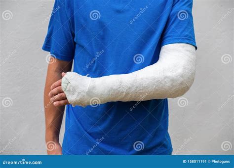 Man With Broken Arm Wrapped Medical Cast Plaster Fiberglass Cast