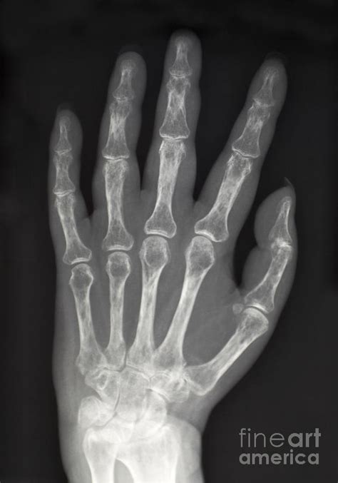 X Ray Showing Severe Osteoporosis Photograph By Scott Camazine