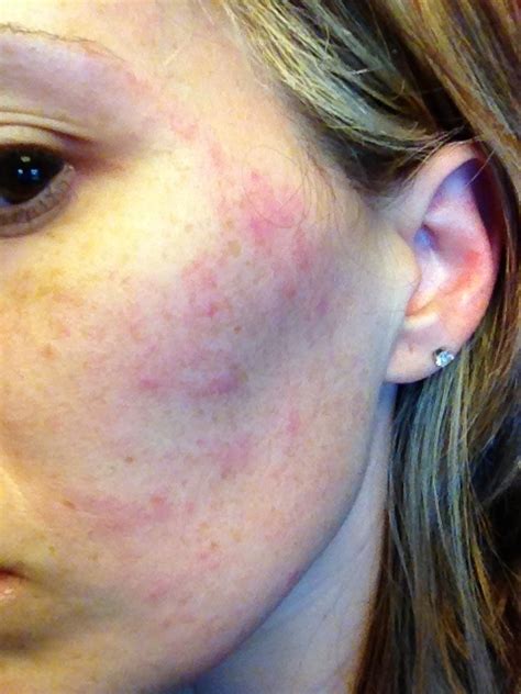 Little Bumps On My Face Allergic Reaction Quiz Lumps Under Skin Behind