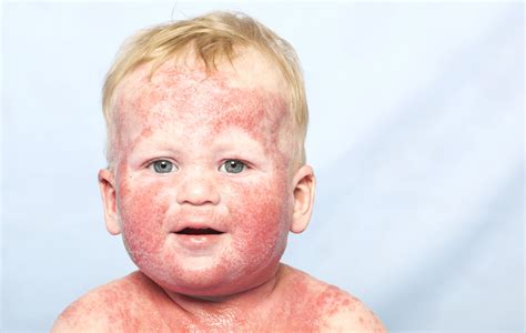 Aprender Sobre 40 Imagem Dermatite Atópica Fotos Vn
