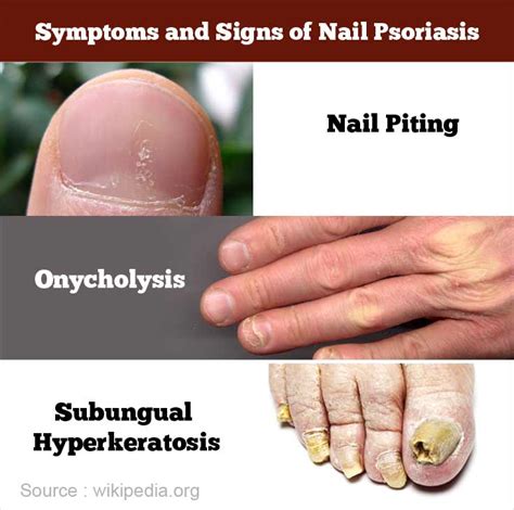 Nail Psoriasis Causes Symptoms Diagnosis Treatment And Prevention