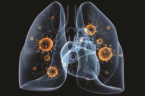 Sometimes symptoms are not severe at first, leading to walking pneumonia. What Is Pneumonia and Why Can It Be So Deadly?