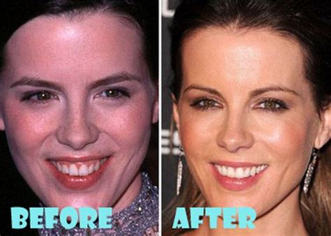 Kate Beckinsale Plastic Surgery Before and After | Kate ...