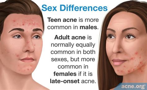 How Is Teen Acne Different From Adult Acne