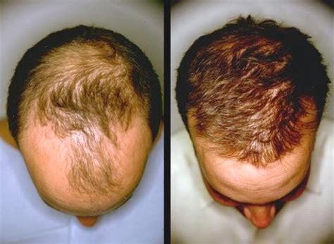 Find out tea tree oil benefits for hair and how to use it as a remedy for hair problems. Cómo usar y preparar jugo de cebolla para crecer y ...