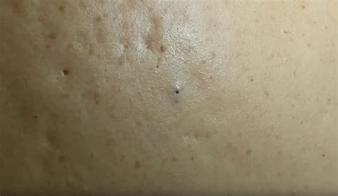 Removing Lots Of Blackheads From The Back New Pimple Popping Videos