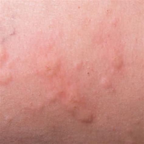 How To Identify 9 Common Skin Rashes Essential Oil For Hives