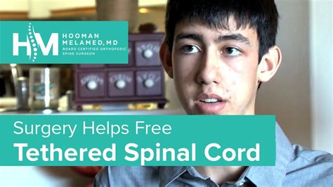 Tethered Spinal Cord Freed By Surgery The Spine Pro Youtube