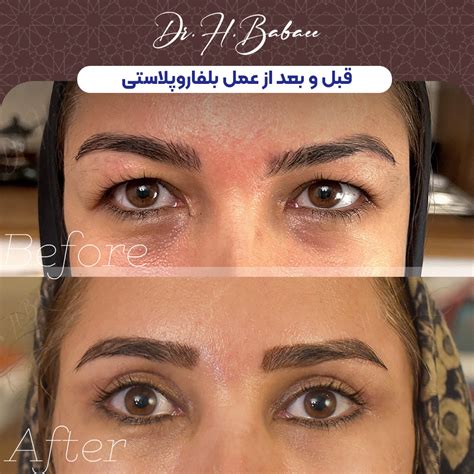 Eyelid Surgery Or Blepharoplasty In Iran Costs And Recommendations