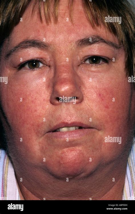 Angioedema Hi Res Stock Photography And Images Alamy