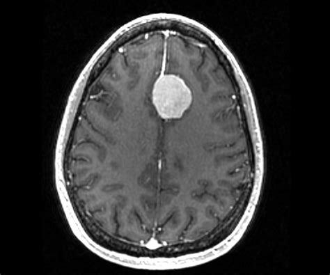 Brain Mri Scan Tumor