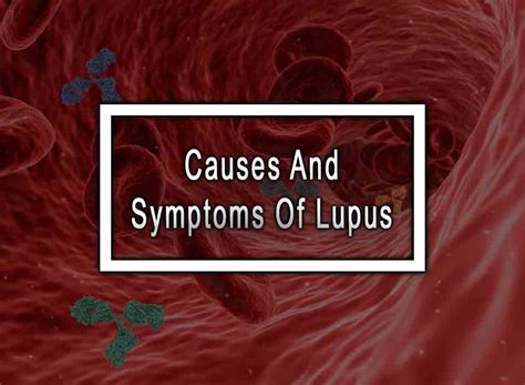 Causes And Symptoms Of Lupus Hanapph