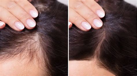 How To Hide A Bald Spot On Crown With Picture And Video Tutorial