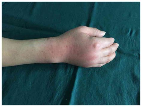 Treatment Of Gout Combined With Kienböcks Disease A Case Report