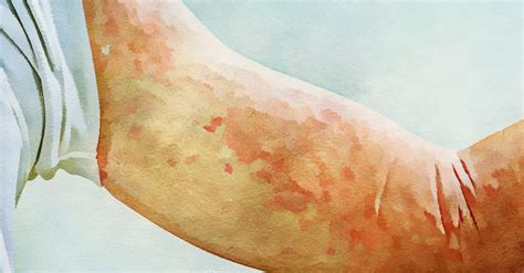 5 Common Rashes And What To Do About Them Curejoy