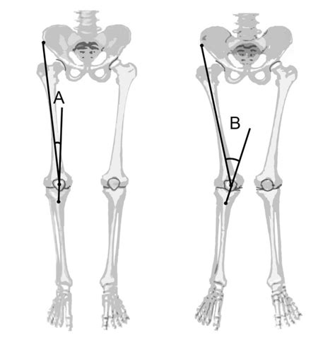Q Angle Of Normal Knee Joint Is Close To A Whereas In Valgus Knee Download Scientific