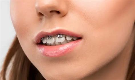 Aligning Your Smile Naturally Benefits Of Holistic Titanium Braces
