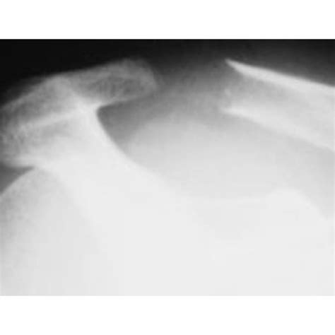 Osteolysis Of The Acromioclavicular Joint Shoulder Surgeon South