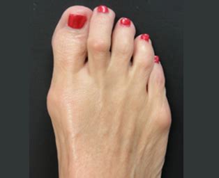 Tailor's bunion (bunionette or digitus quintus varus) is a condition caused as a result of inflammation of the fifth metatarsal bone at the base of the little tailor's bunion is easily diagnosed because the protrusion is visually apparent. Tailor's Bunion - Da Vinci Foot and Ankle