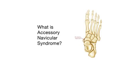 Accessory Navicular Syndrome Symptoms And Treatment Visalia Podiatrist