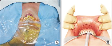 Figure 2 From Transoral Endoscopic Thyroidectomy For Papillary Thyroid