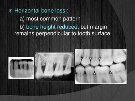 Bone Loss And Patterns Of Bone Destruction
