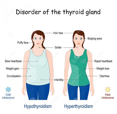 Hyperthyroidism Symptoms Causes Diagnosis And More Ltg
