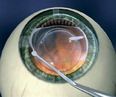 Implantable Contact Collamer Lens Dr Lynn Yeo Experienced Eye Surgeon Singapore