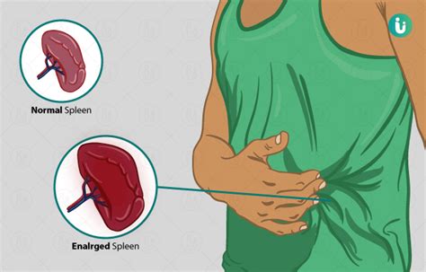 Enlarged Spleen Symptoms Causes Treatment Medicine Prevention