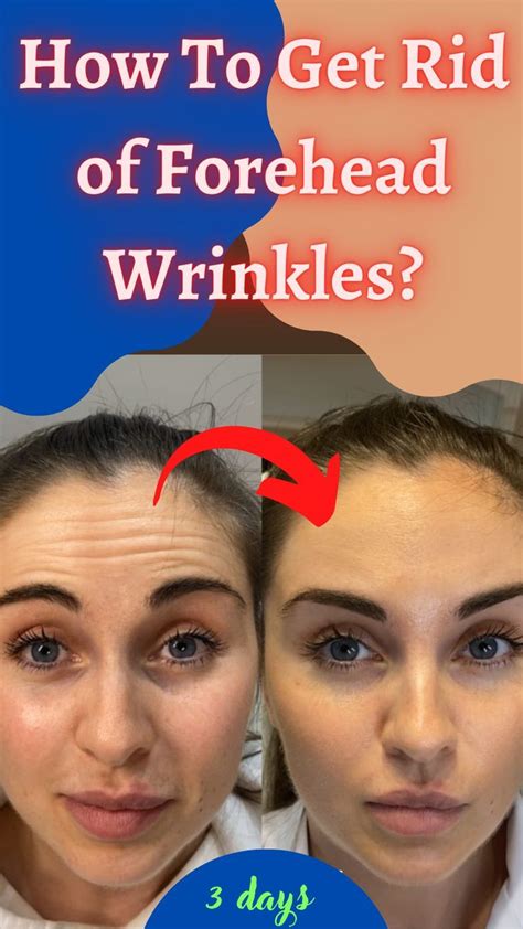 How To Get Rid Of Forehead Wrinkles In 3 Days In 2022 Forehead
