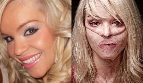 Katie Piper Before And After Surviving A Brutal Acid Attack Otakukart