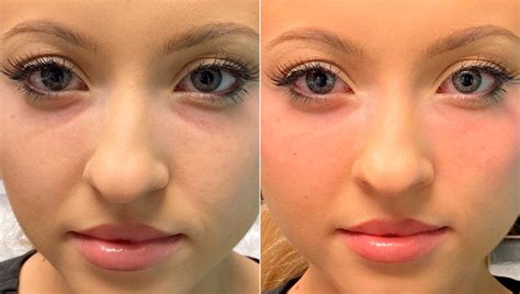 Tear Trough Under Eye Injections Before And After Photos The Naderi Center For Plastic