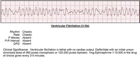 Ventricular Fibrillation Ecg Acls Wiki