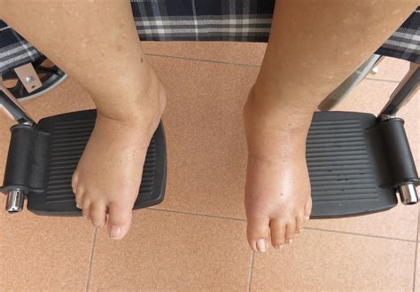 Edema Swelling In Legs From Obesity Vs Heart Failure Scary Symptoms