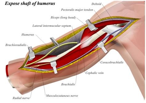 Anterolateral Approach To Distal Humerus Approaches Orthobullets