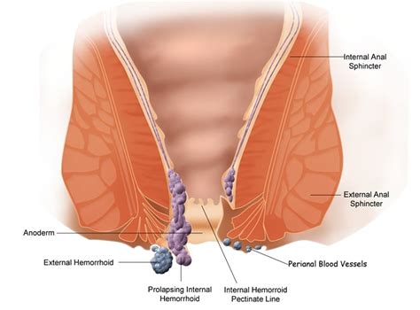 Hemorroides externas causas síntomas y tratamientos
