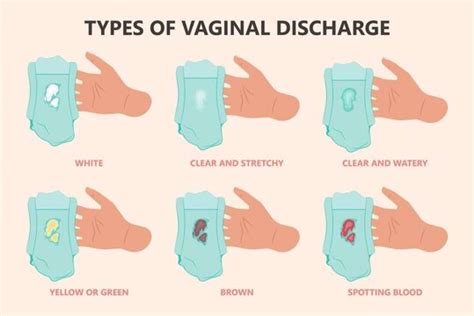 Is White Discharge Before Period Sign Of Pregnancy 5 Best Causes Of