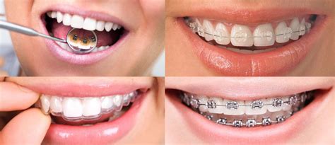 Ortodoncia And Brackets Mi Dentista Ortodoncia And Brackets