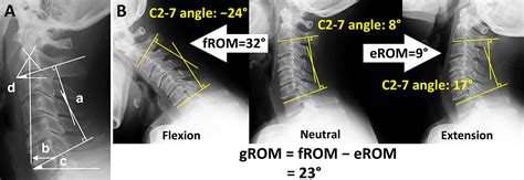 Gap Between Flexion And Extension Ranges Of Motion A Novel Indicator
