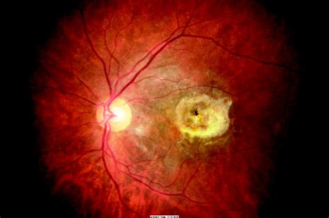 Retinal Signs And Stroke Stroke