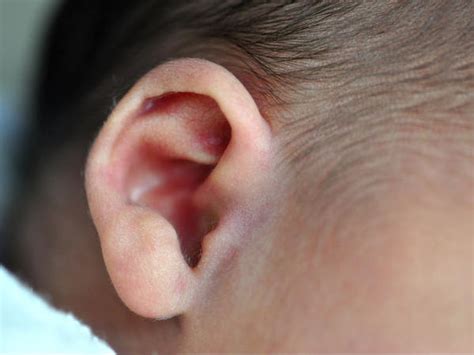 Ear Infection Outer Ear Care Plan Planning For Care