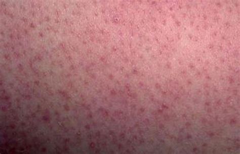 Keratosis Pilaris Results In Red Dots On Legs And Arms