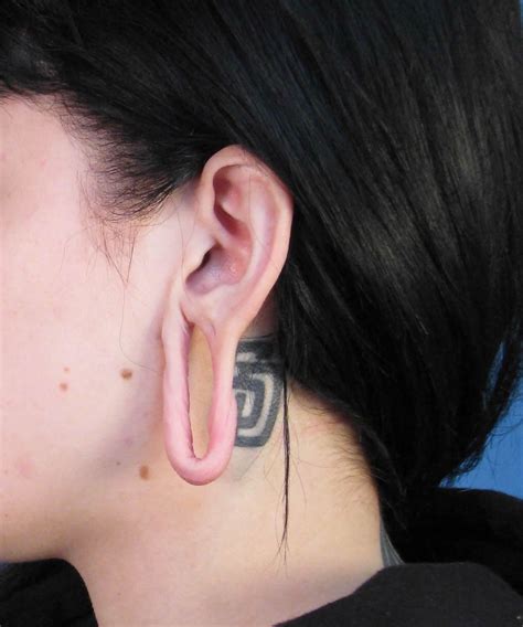 San Diego Plastic Surgery Of The Ear Reshaping Surgery Otoplasty