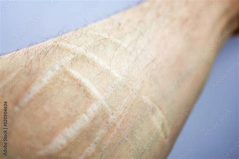 Scars From Cuts On The Arm Suicidecut Marks On Arms Stock Photo