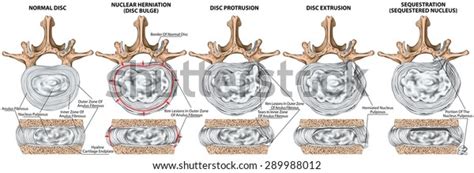 Types Stages Lumbar Disc Herniation Herniated Hình Minh Họa Có Sẵn