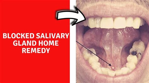 Blocked Salivary Gland Home Remedy 4 Ways To Treat Salivary Gland
