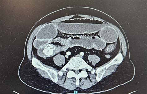 Unusual Complications Of Gallstones Case 2